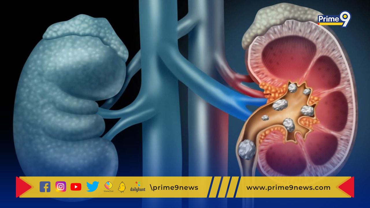 Kidney Stones: కిడ్నీలో స్టోన్స్ ఉన్నాయని ఎలా తెలుస్తుంది?